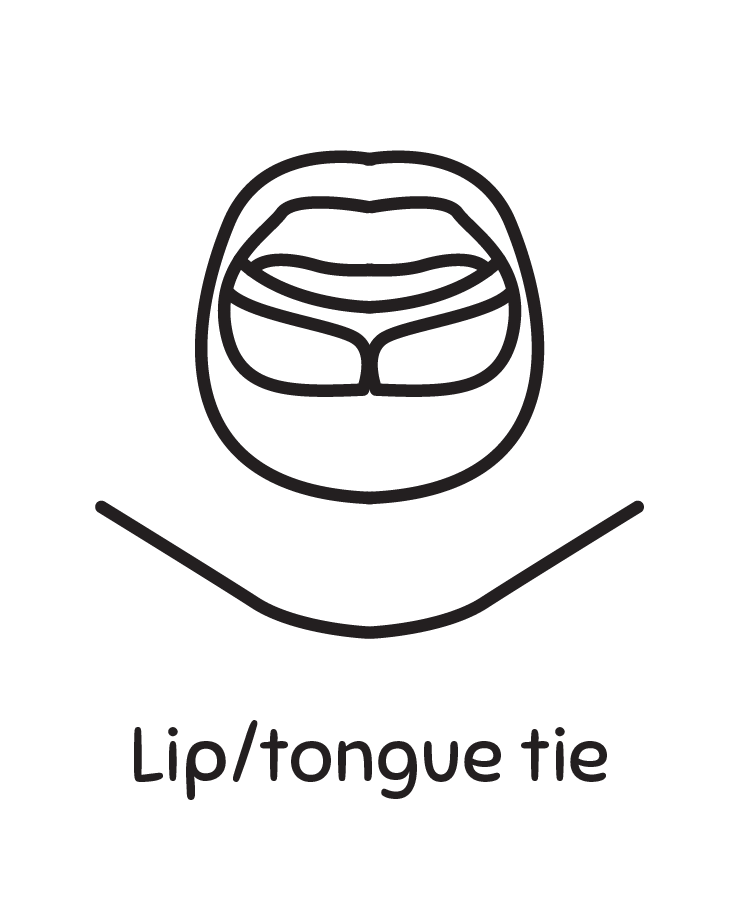 Lip/tongue Tie